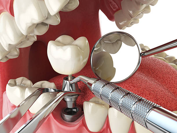 Best Emergency Wisdom Tooth Extraction in Hebron, NE