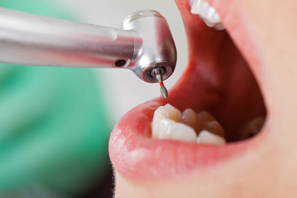 Best Knocked-Out Tooth (Avulsed Tooth) Treatment in Hebron, NE